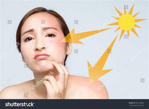 Young Woman Bad Sunburn On Her Stock Photo 622248086 Shutterstock