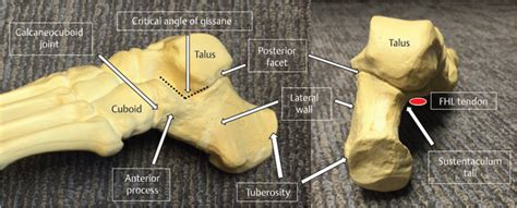 45 Calcaneus Fractures Musculoskeletal Key