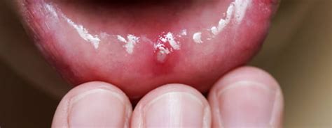 Canker Sores Treatments Causes And Prevention Orion Dental