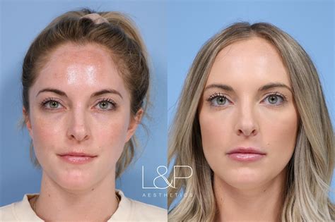 Flawless Fillers And Botox Treatment For This Beauty