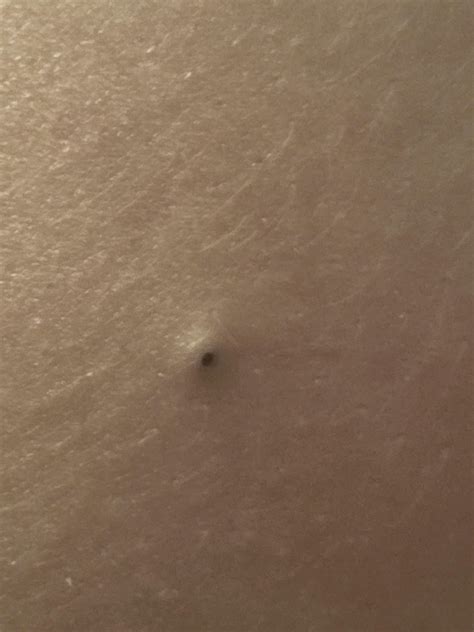Bf popped a giant (back) blackhead : r/popping