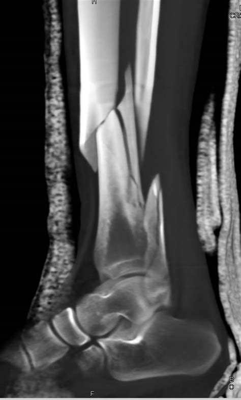 Spiral Fracture Of The Distal Tibia And Fibula Musculoskeletal Case