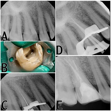 Cureus Non Surgical Root Canal Treatment Of An Upper First Molar With