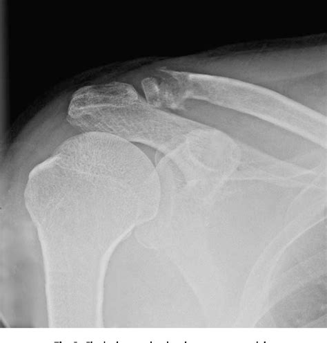 Figure 3 From Treatment Of Unstable Distal Clavicle Fractures Using Two