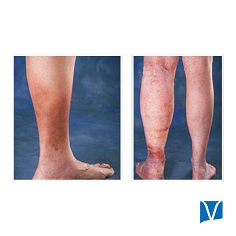 Wondering Why Your Ankles Inovia Vein Specialty Centers