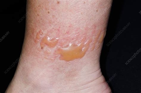 Allergic Reaction To Lycra Socks Stock Image C0168183 Science