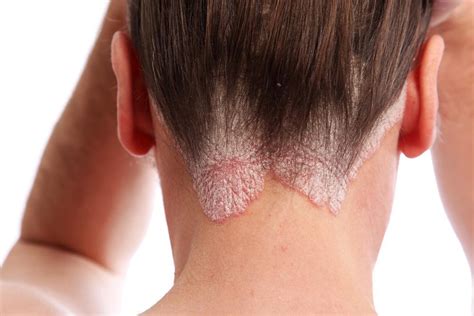 Dermatite Seborreica O Que Causas Sintomas E Tratamentos Sa De Dicas The Best Porn Website