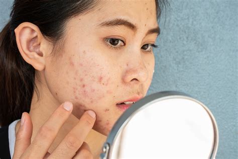 An In Depth Look Into Acne Scars Causes And Treatment