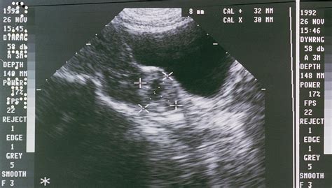 Ultrasound Image Showing An Ectopic Pregnancy Photograph By Science