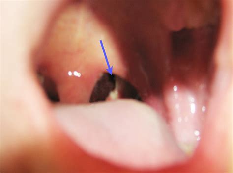 Hole In Tonsil Area After Tonsillectomy Fauquier Ent Blog