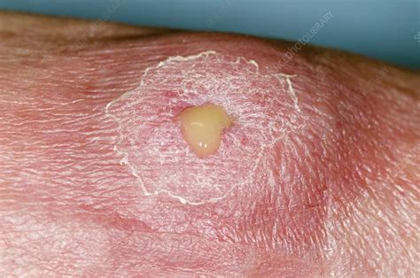 Abscess On The Foot Stock Image C0130843 Science Photo Library