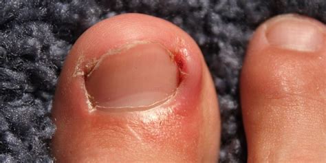 How To Prevent And Treat Ingrown Toenails Foot And Ankle