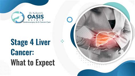Stage 4 Liver Cancer Everything You Need To Know