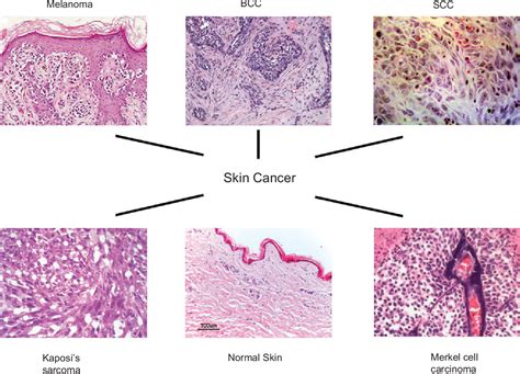 Merkel Cell Histology Histopathology Images Of Small Cell Carcinoma