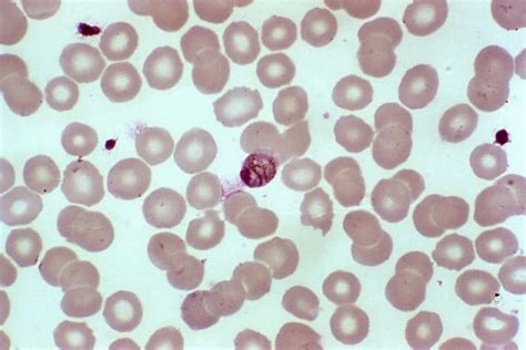 Free Picture Thick Film Blood Smear Micrograph Numerous Ring Form Plasmodium Falciparum