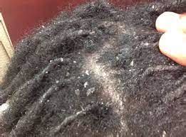 We did not find results for: How to Get Rid of Dandruff in Dreadlocks? - Dreadlocks Club