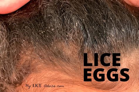 Biggest Head Lice Ever Found Lomilogin
