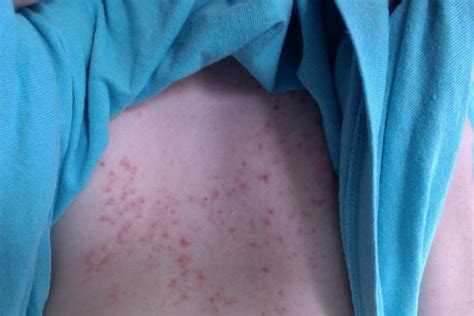 Red Itchy Rash With Pimples