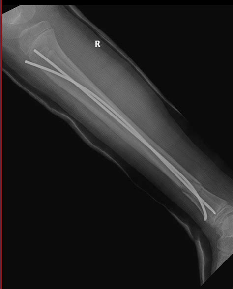 Case Open Tibial Shaft Fracture In An 11m