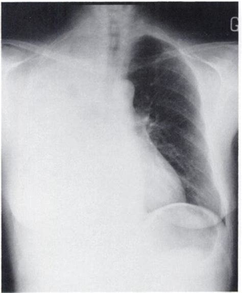 A Chest X Ray With A Large Right Pleural Effusion B Complete My Xxx Hot Girl
