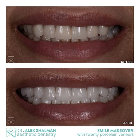 Before After Gallery Shalman Dentistry In Lower Manhattan Ny
