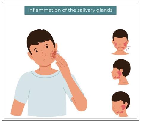 Salivary Glands Disorders Everything Your Need To Know Dentist Ahmed