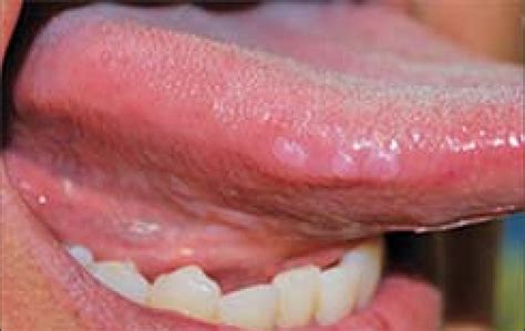 Three Separate Feh Lesions Of Right Lateral Tongue Border Download