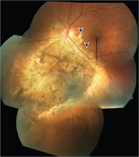 Regression Of Choroidal Metastasis Breast Cancer Jama Ophthalmology