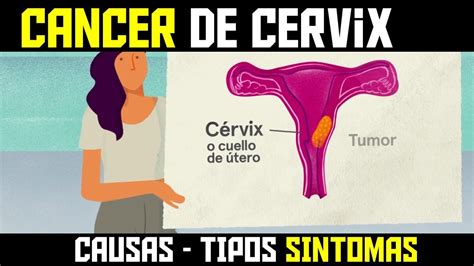 Hemorragia o secreción vaginal fuera de lo normal. QUE ES EL CANCER DE CUELLO UTERINO - SINTOMAS CAUSAS Y ...