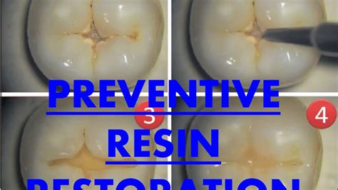 Preventive Resins Restorations Conservative And Endodontics Youtube