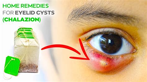 Chalazion Treatment Home Remedies For Eye Stye Youtube