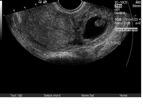 Left Tubal Ectopic Pregnancy Image