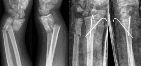 Re Displacement Of Stable Distal Both Bone Forearm Fractures In
