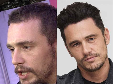 While hair transplant is a delicate procedure, these aftercare essentials will help you. James Franco Hair Transplant - Hair Analysis by Matt Dominance