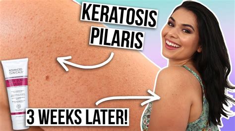 How I Treat My Keratosis Pilaris On Arms No More Dry Bumpy Skin