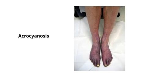 Circumoral Cyanosis List Of Causes Risks Daily Health Cures