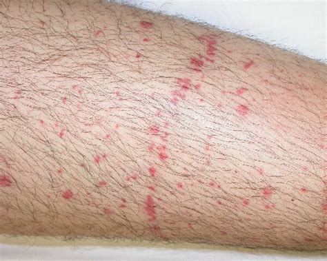 Petechiae Pictures Causes Symptoms Diagnosis And Treatment