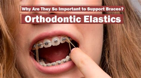 How Do Orthodontic Elastics Provide Support For My Braces