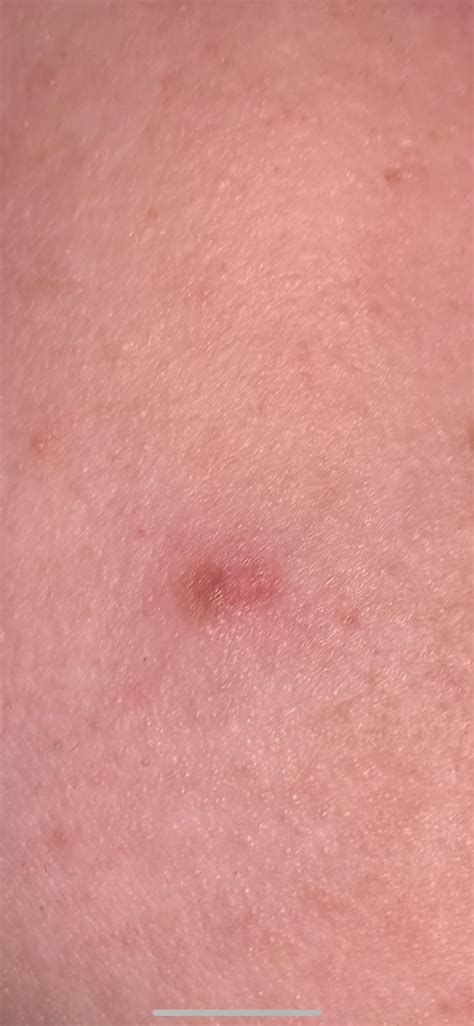 Something I Should Get Checked Out Raised Bump On Side Of Cheek Which