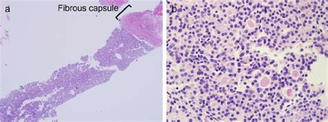 A Representative Case Of Follicular Neoplasm Diagnosed In A Core Needle