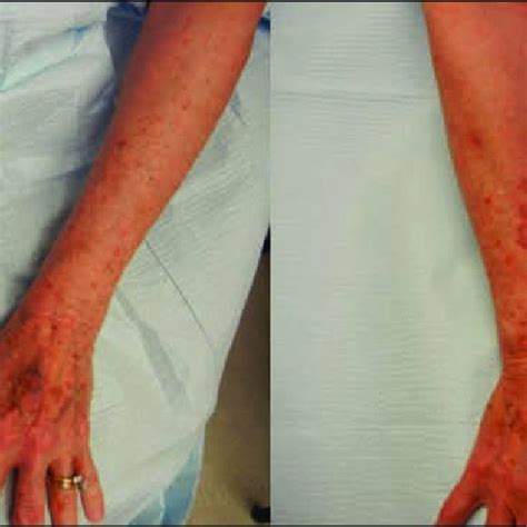 The Appearance Of Actinic Purpura Left Is Greatly Improved After