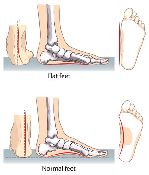 Flat Feet Symptoms Treatments And More Red Mountain Footcare