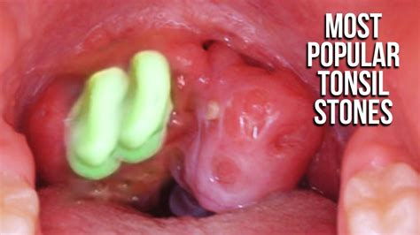 Most Popular Tonsil Stone Removals On Youtube Youtube