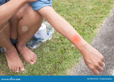 Mosquito Bites Arm Women In The Park Stock Image Image Of Alone