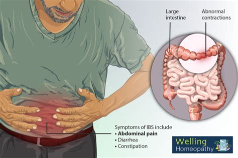 What Causes Irritable Bowel Syndrome Treatment Cure Of Ibs