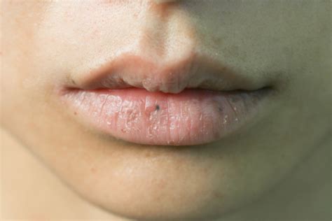 Cosas Que Tus Labios Dicen Acerca De Tu Salud Labios Con Hormigueo