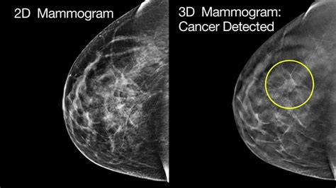 Early Detection Using 3d Mammography Improves Survival Health