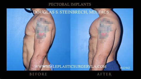 Pectoral Implants Gallery Male Plastic Surgery Los Angeles