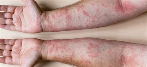 What Are The Causes Of An Itchy Rash On The Body Healthy Food Near Me