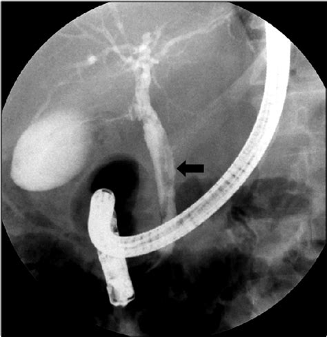 Ercp Finding A Longitudinal Tubular Filling Defect Was Shown On The